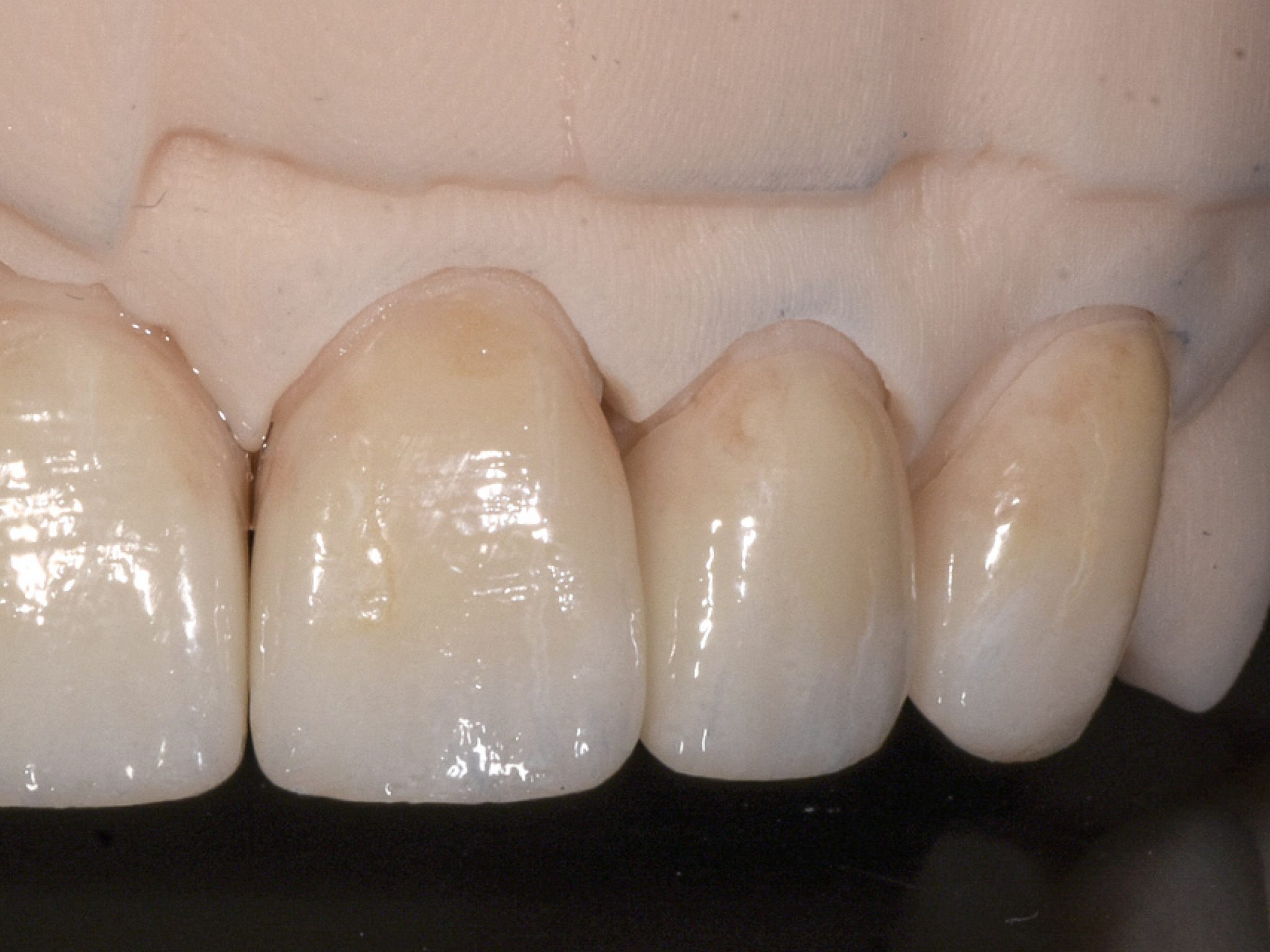 AllCeramic Restorations • Triad Dental Studio